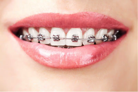 Palate Expanders From a Braces Dentist Near Me