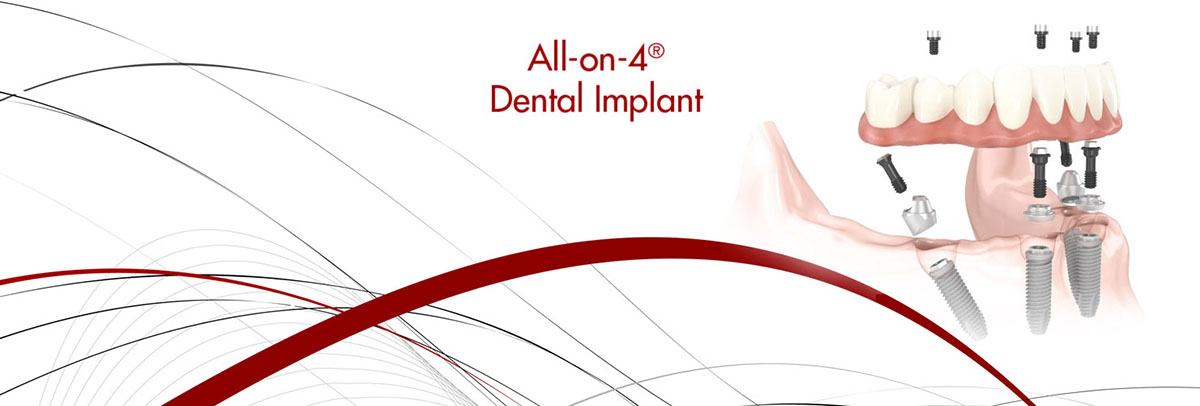 Implantes dentales All-on-4