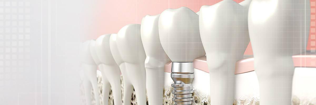 Implantes dentales