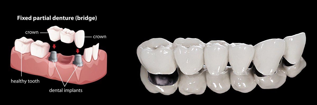 Dentaduras postizas y prótesis parciales (Copia)