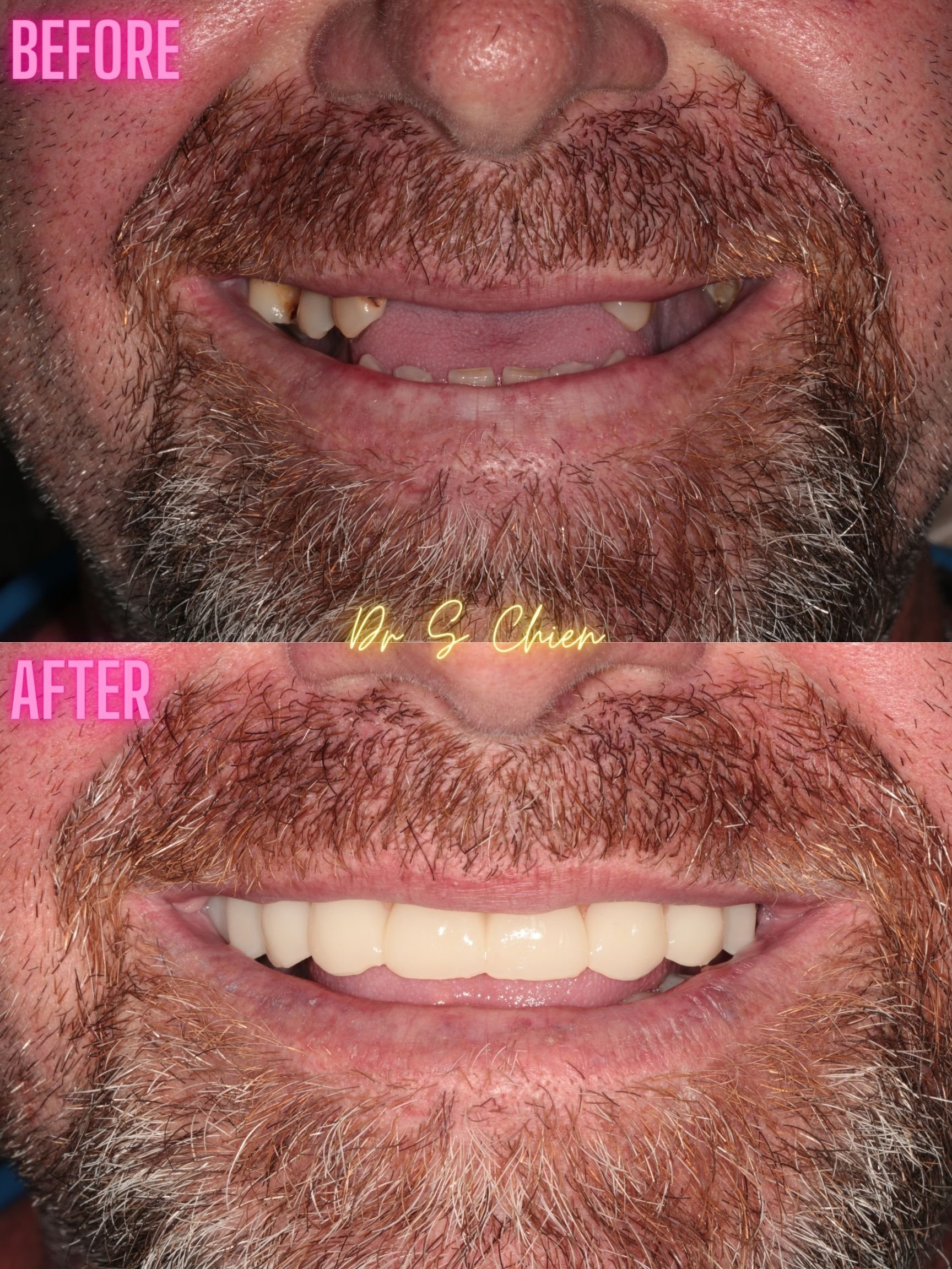 Dental Implants Full face transformation