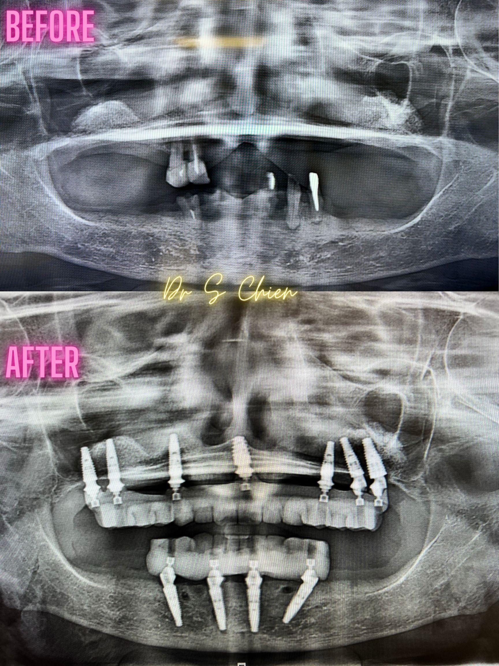 Implant Denture X-Ray All on 4, All on 6