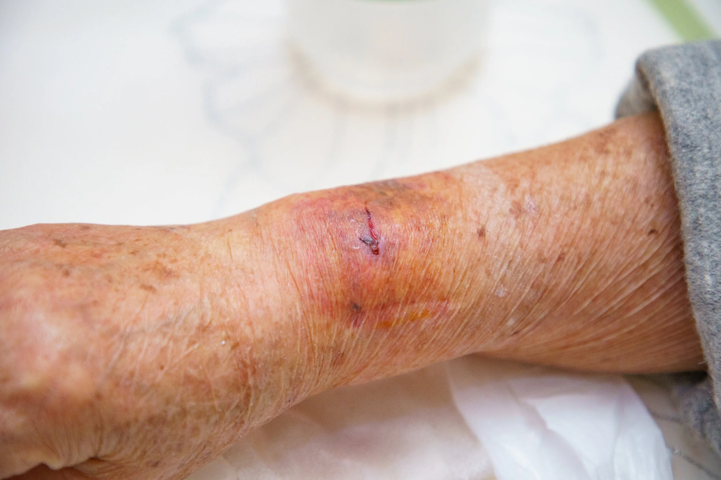 wound.jpeg