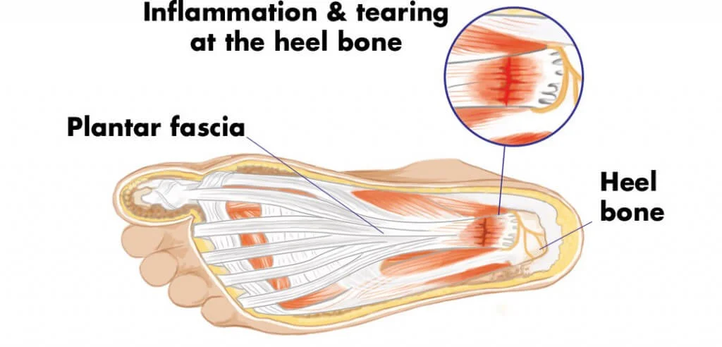plantar fasciitis.jpg