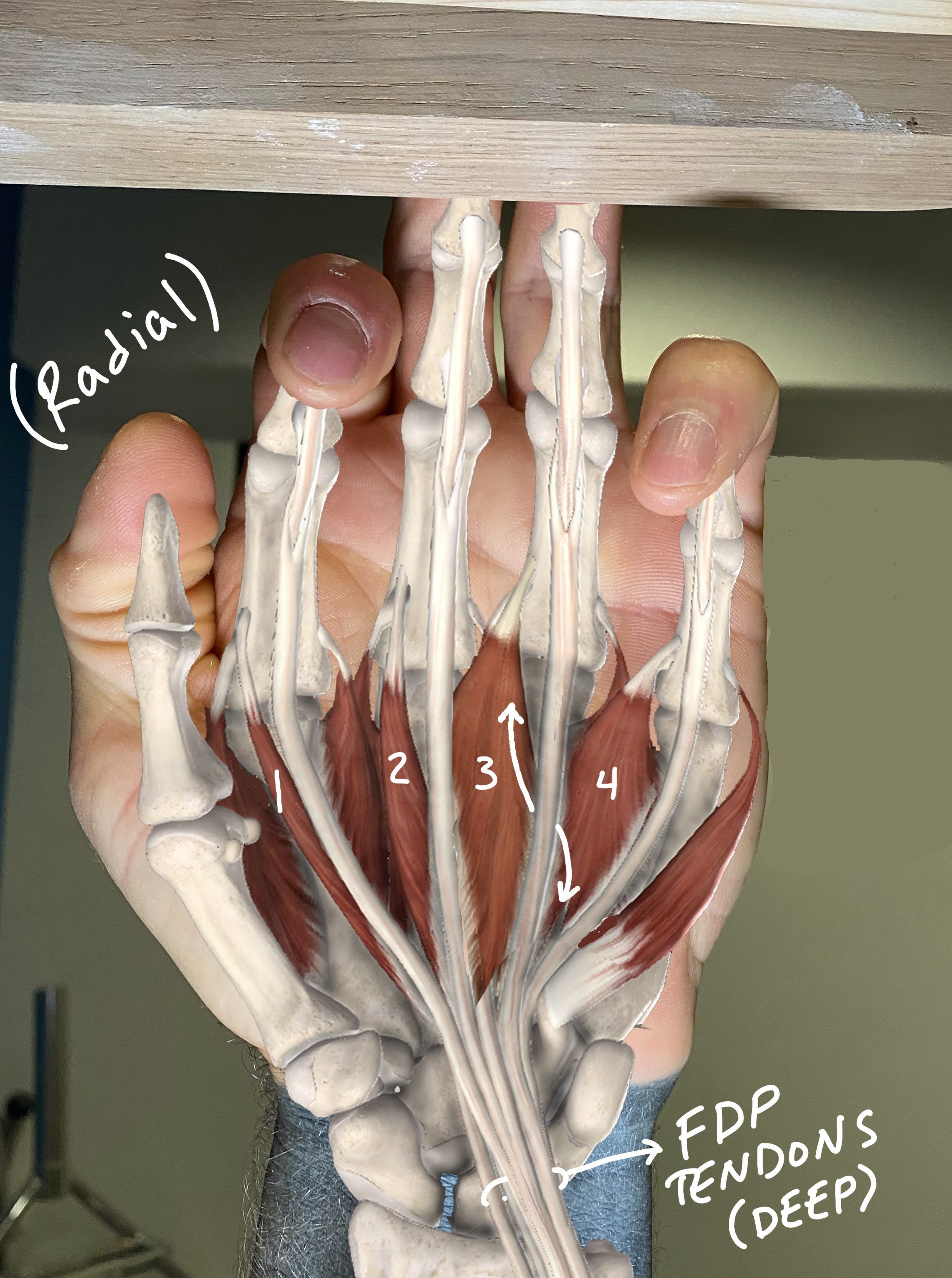 Understanding Lumbrical Muscle Injuries