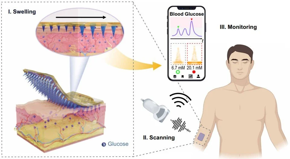 Augmenting ultrasound for continuous glucose monitoring via a wearable ...