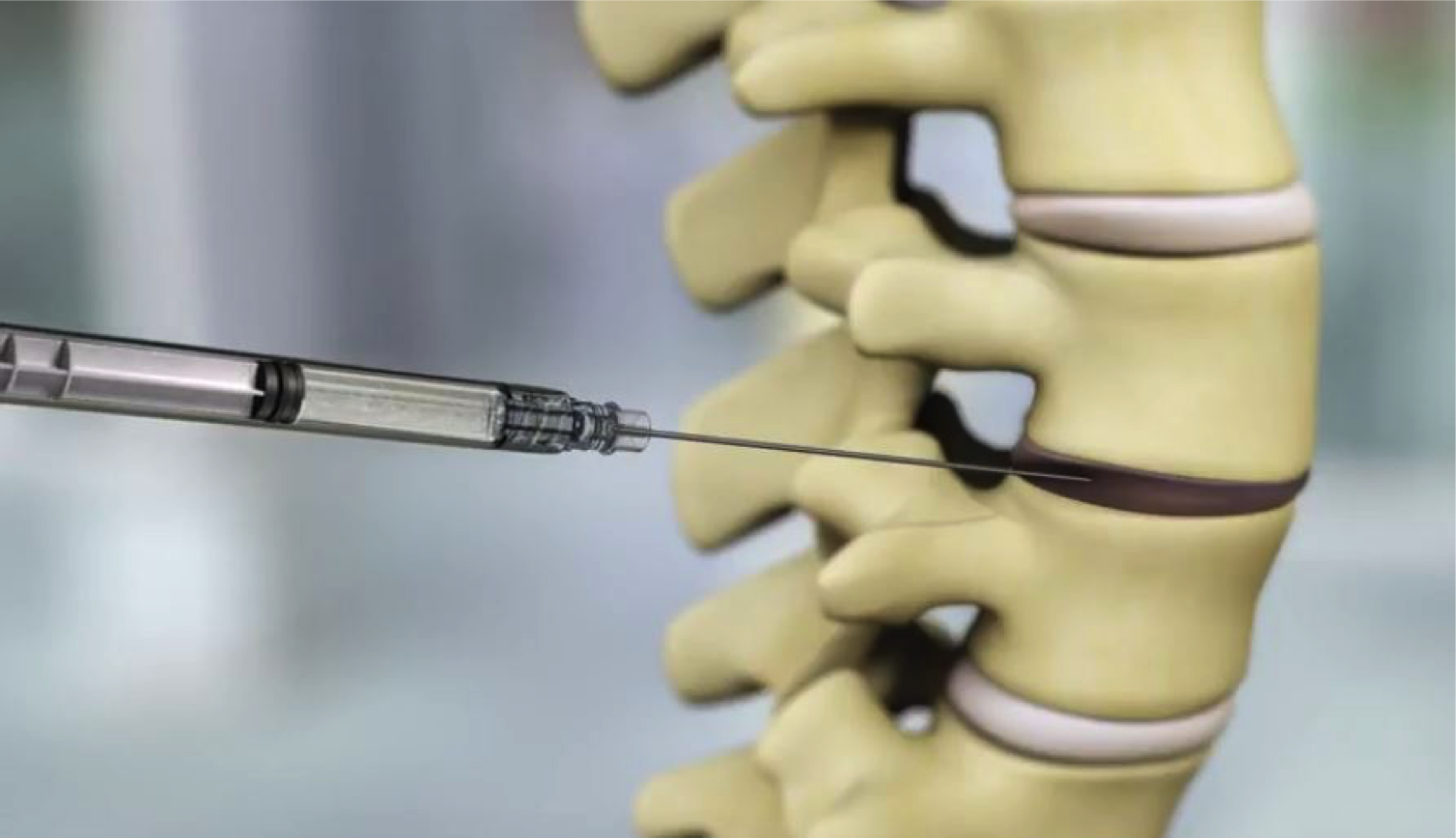 DiscGenics Announces U.S. Clinical Study of Cell Therapy for Disc Degeneration  Clears Final Planned Safety Review