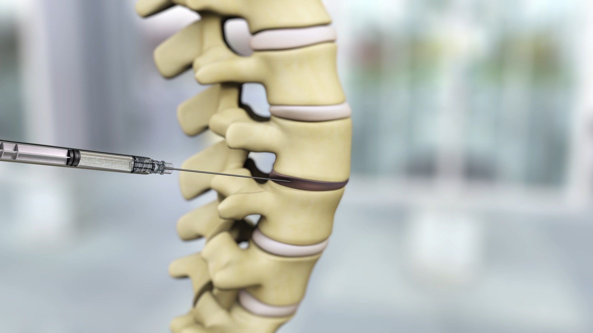 The International Journal of Spine Surgery Has Published Results from an FDA-Approved Study of an Allogeneic Disc Progenitor Cell Therapy for the Treatment of Adults with Lumbar Disc Degeneration