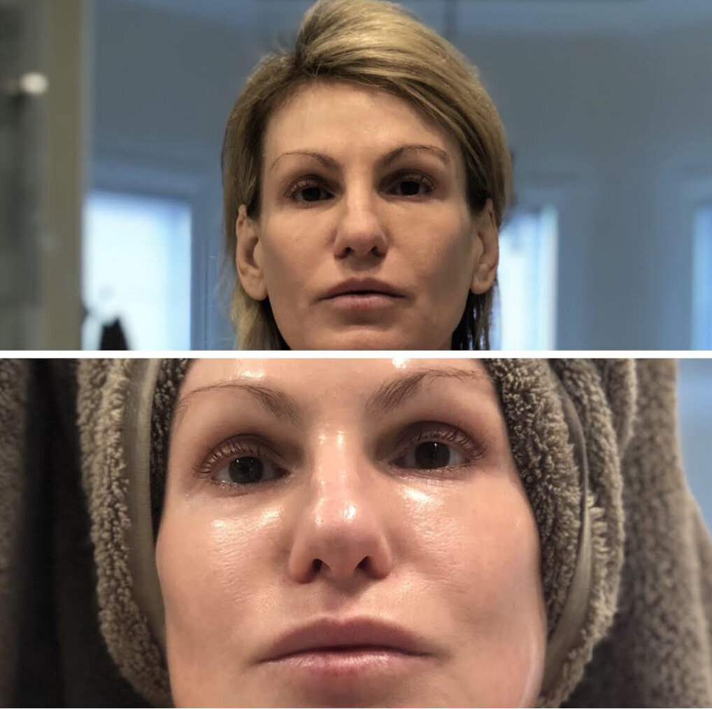 Before My Perfect Facial (above), after (lower).&nbsp; These are unfiltered photos before and after with nothing on the skin.&nbsp; I am enjoying my new dewy rosy complexion these days and have gotten several compliments about my skin.&nbsp; I think…