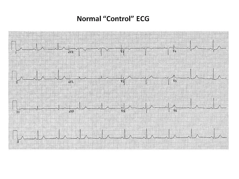 Upside Down ECG Figure 1.jpg