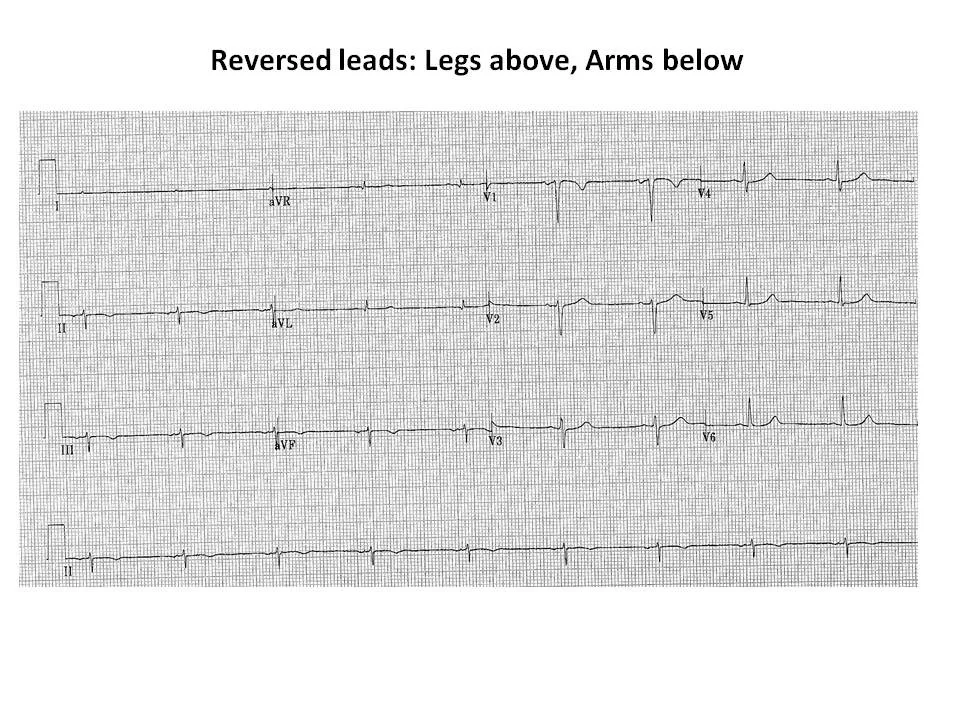 Upside down ECG Figure 2.jpg