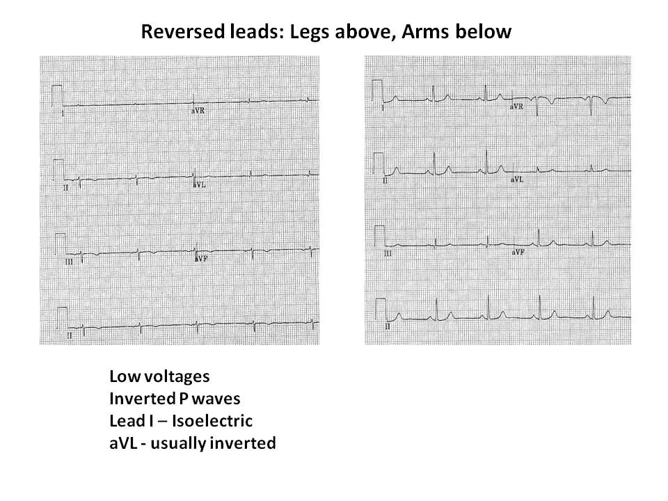 Upside Down ECG Figure 3.jpg