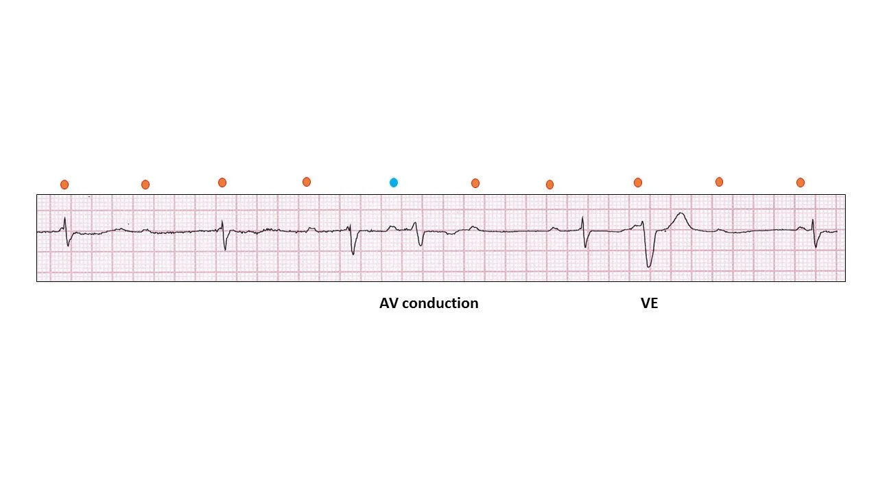 Complete Heart Block 1.jpg