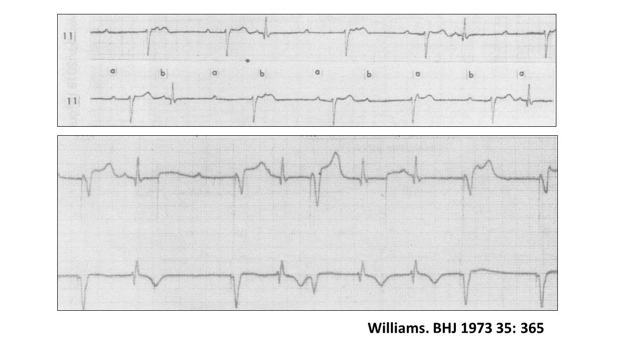 complete heart block 3.jpg