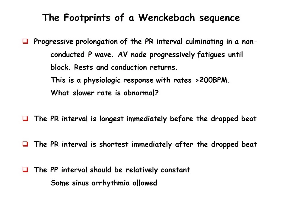 footprints of wenckebach sequence.jpg