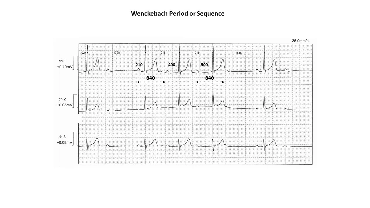 wenckeback sequence.jpg