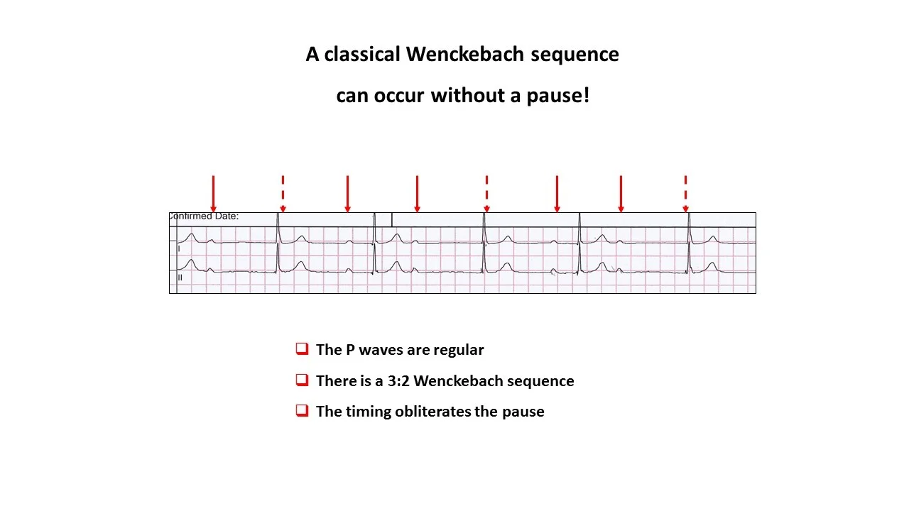 classical wenckeback without a pause.jpg