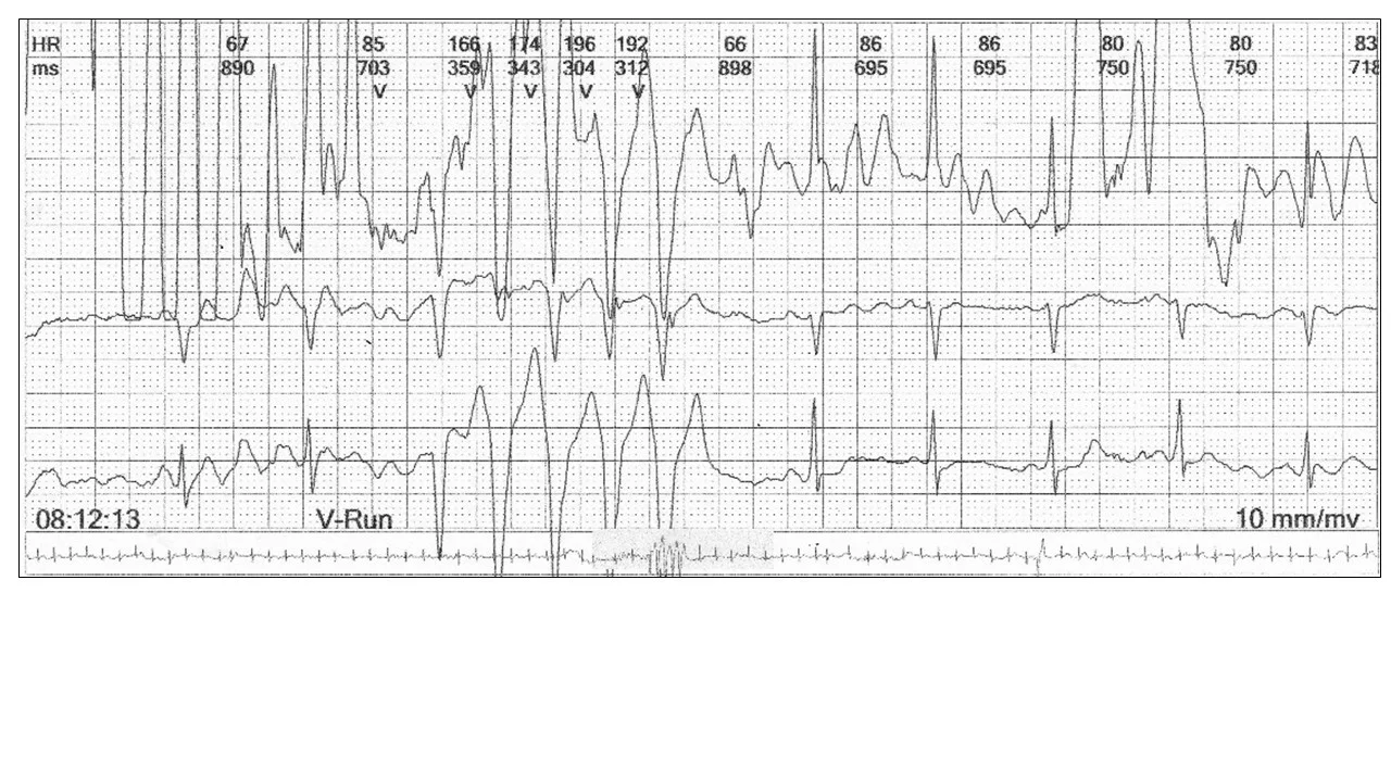 Image 4: In this example, you require three channels to diagnose artefact and exclude ventricular tachycardia.