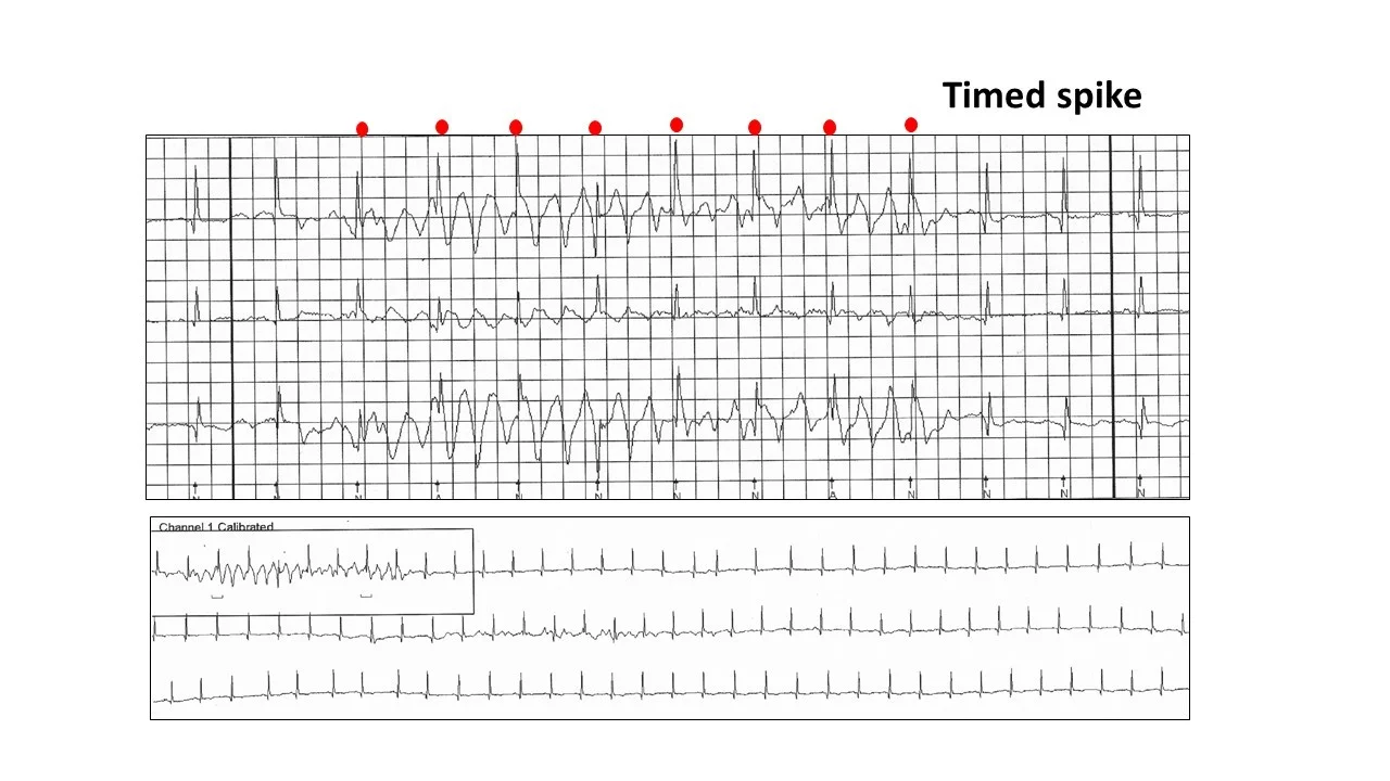 Image 8: The timed spikes are the sinus QRS waves. Three channels are required to exclude a ventricular tachyarrhythmia.