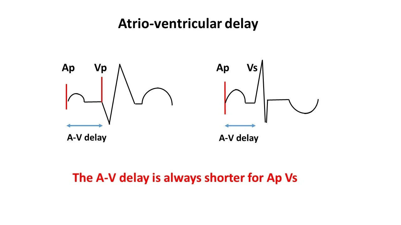 AV delay 1.jpg