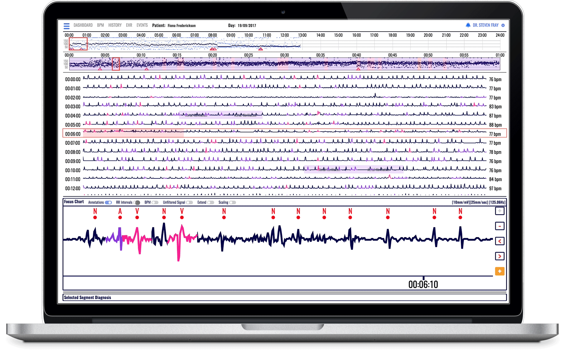 RR-Intervals.gif