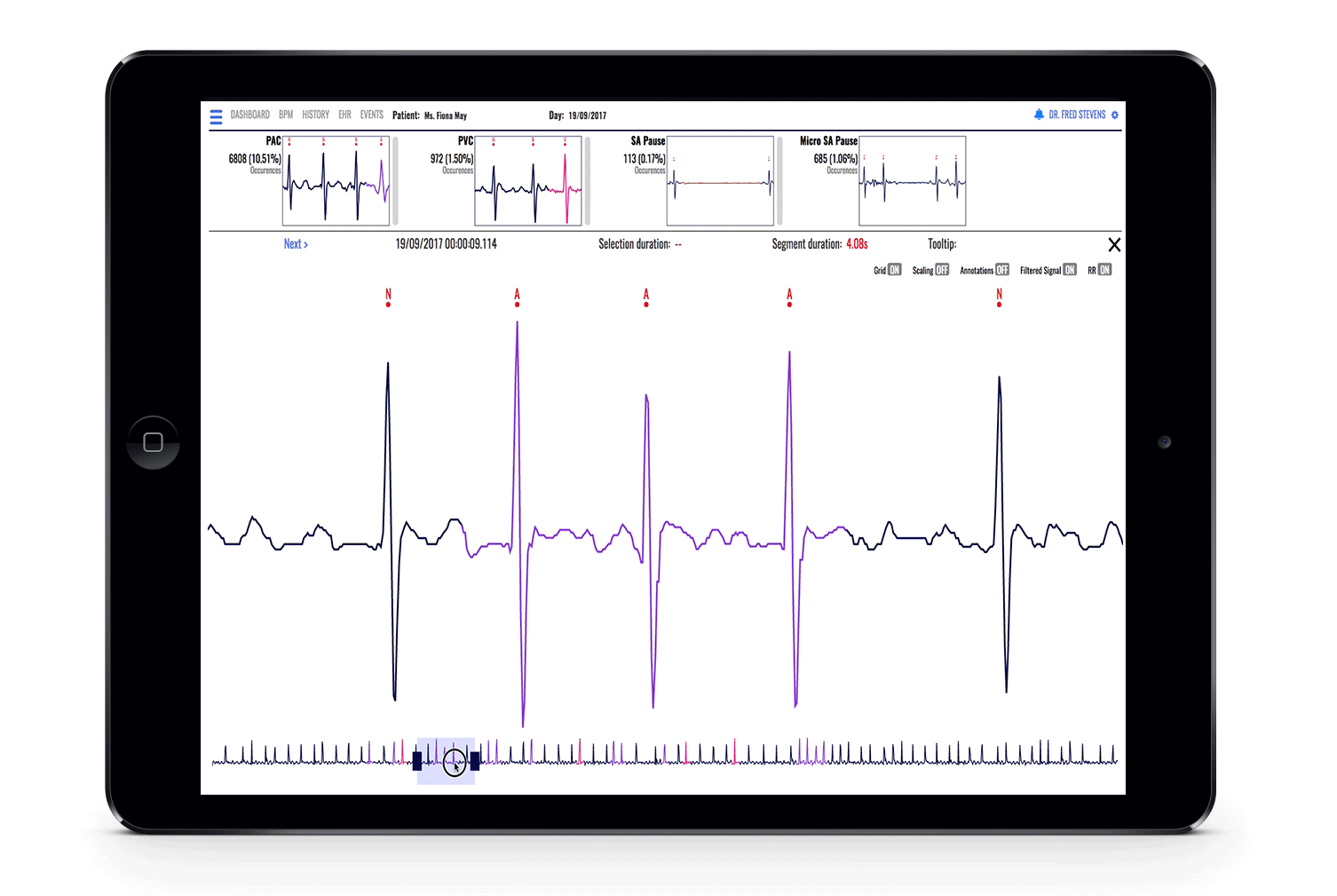 Atrial-Arrhythmia.gif