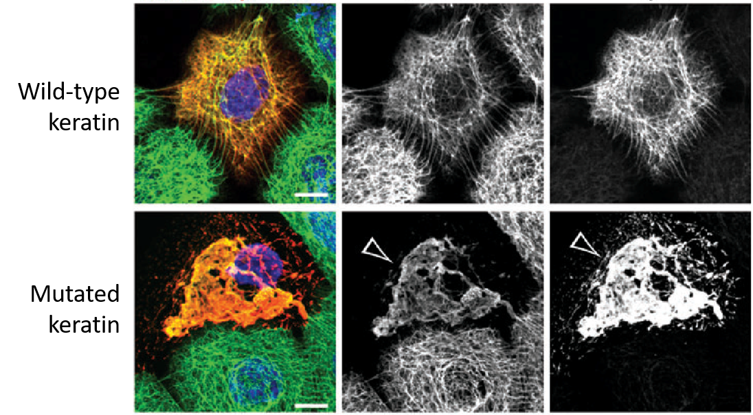 Normal keratin filaments form a strong structural network (top) that enables cells to withstand pressure and stretching. Mutant keratin proteins form clumps (bottom), resulting in weak cells that break under pressure. Kubo, A. et al. (2013) The Journal of Dermatology 40(7):553-7.
