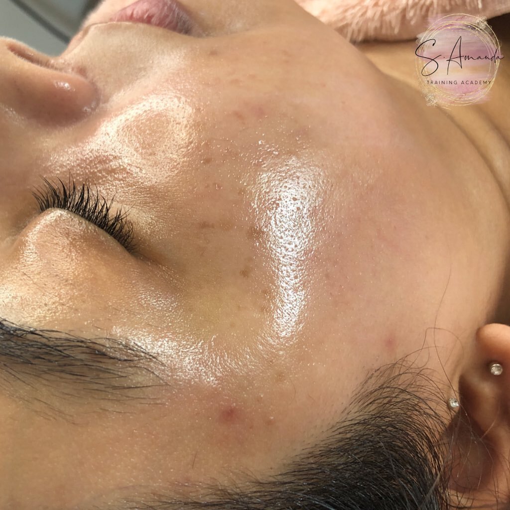 S K I N IS A L W A Y S IN 💦💦 The science behind the Micro-needling facial is fascinating 👀 It&rsquo;s the ultimate SKIN BOOSTER penetrating hyaluronic Acid and Vitamin C into the deeper layers of the skin giving instant, long lasting results ❤️

S