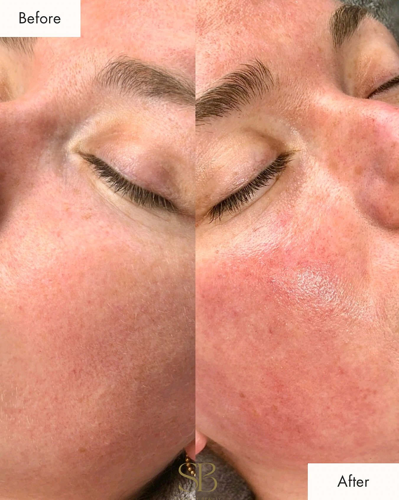 Microneedling is the secret to smoother, brighter skin 🫧🫧

✨ Who is microneedling for? ✨
This treatment is perfect for most skin types, especially if you&rsquo;re looking to reduce acne scars, fine lines, large pores or dull texture 💉

Your glow-u
