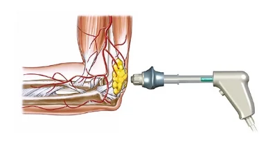 shockwave therapy at OCR