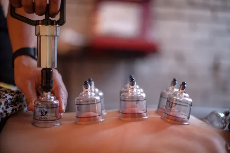 cupping therapy