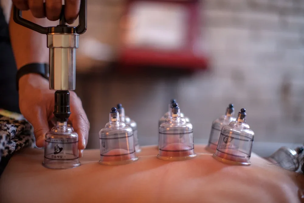 Cupping Therapy ossington