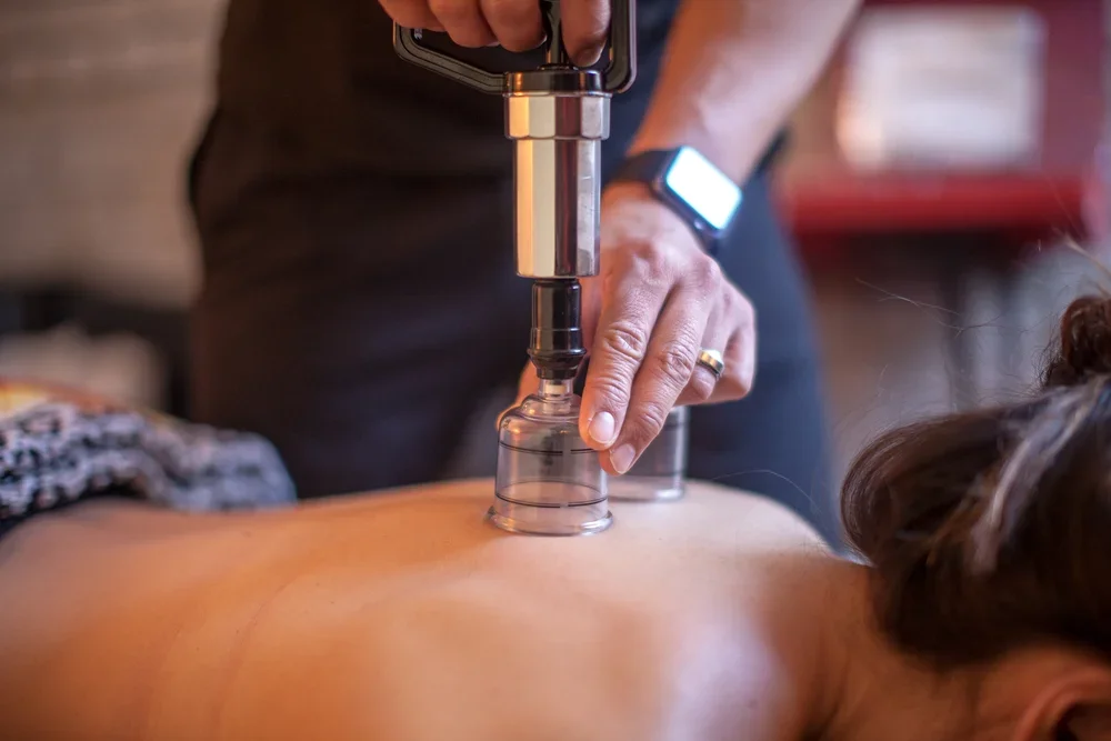 cupping therapy