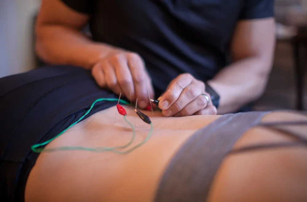 acupuncture