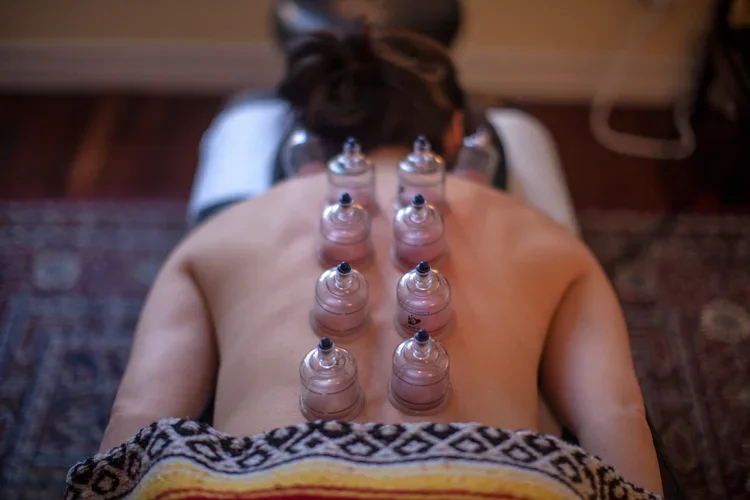 cupping therapy toronto