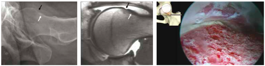 Cam type FAI in a 37-year-old woman and the joint after arthroscopic treatment