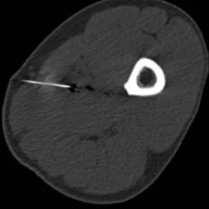 An MRI Scan can be the most useful diagnostic tool