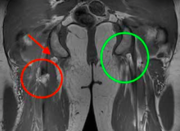 An MRI is the gold standard for identifying hamstring tendon tears. The red circle signifies an injured tendon, whereas the green circle shows a healthy tendon.