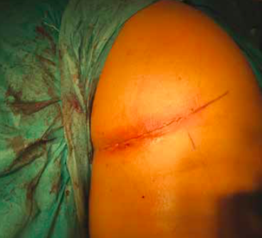 The incision is made in the buttock/upper thigh area where the torn tendon end will be found