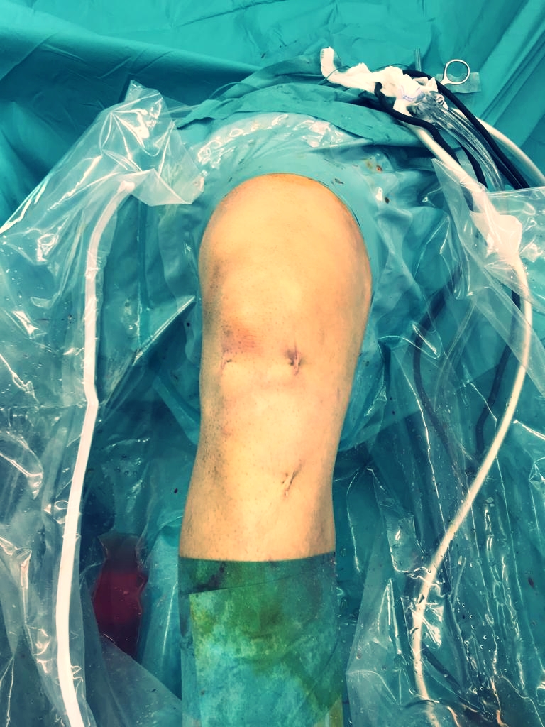 Minimally invasive ACL surgery done - Next step: Pain reduction - by Dr. Andreas Krüger (Zurich)