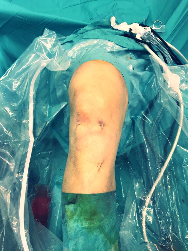 Minimal Invasive ACL-Surgery done - Next step: Pain reduction - by Dr. Andreas Krüger (Zurich)