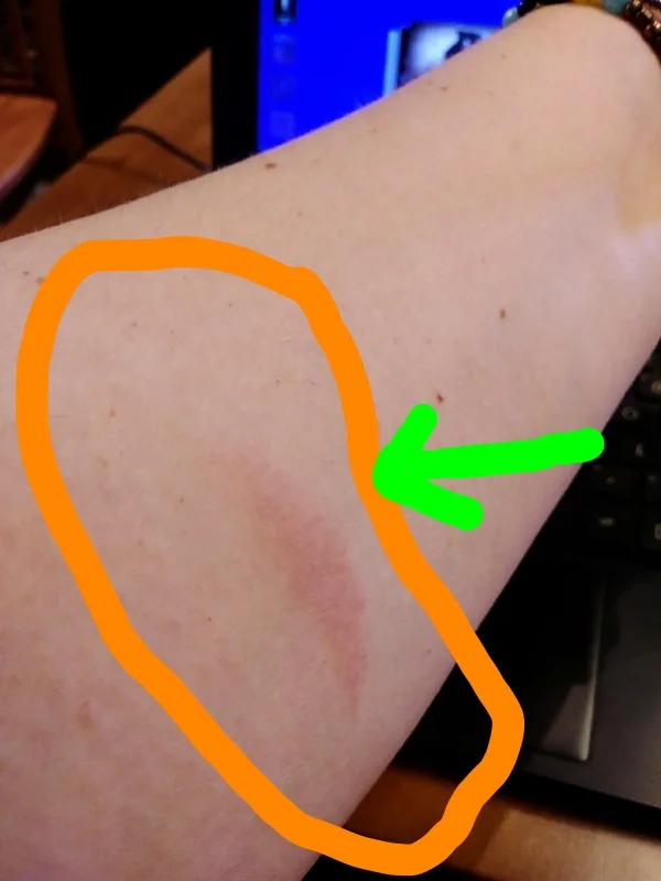 Okay it's not like a 3rd degree injury but OW!