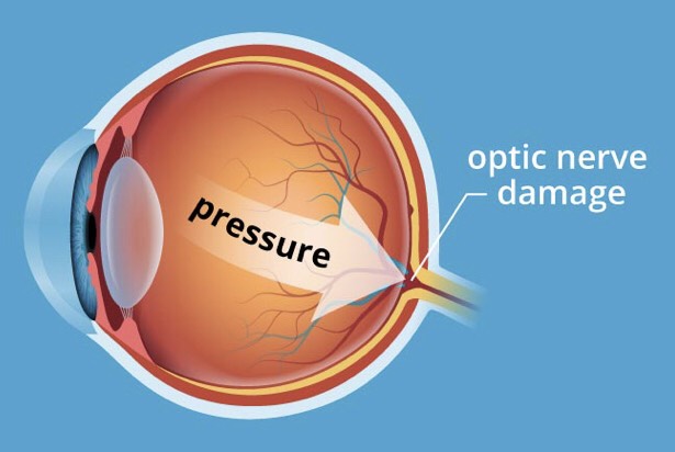 Eye pressure causes damage to optic nerve