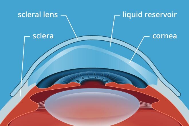 scleral lens.jpg