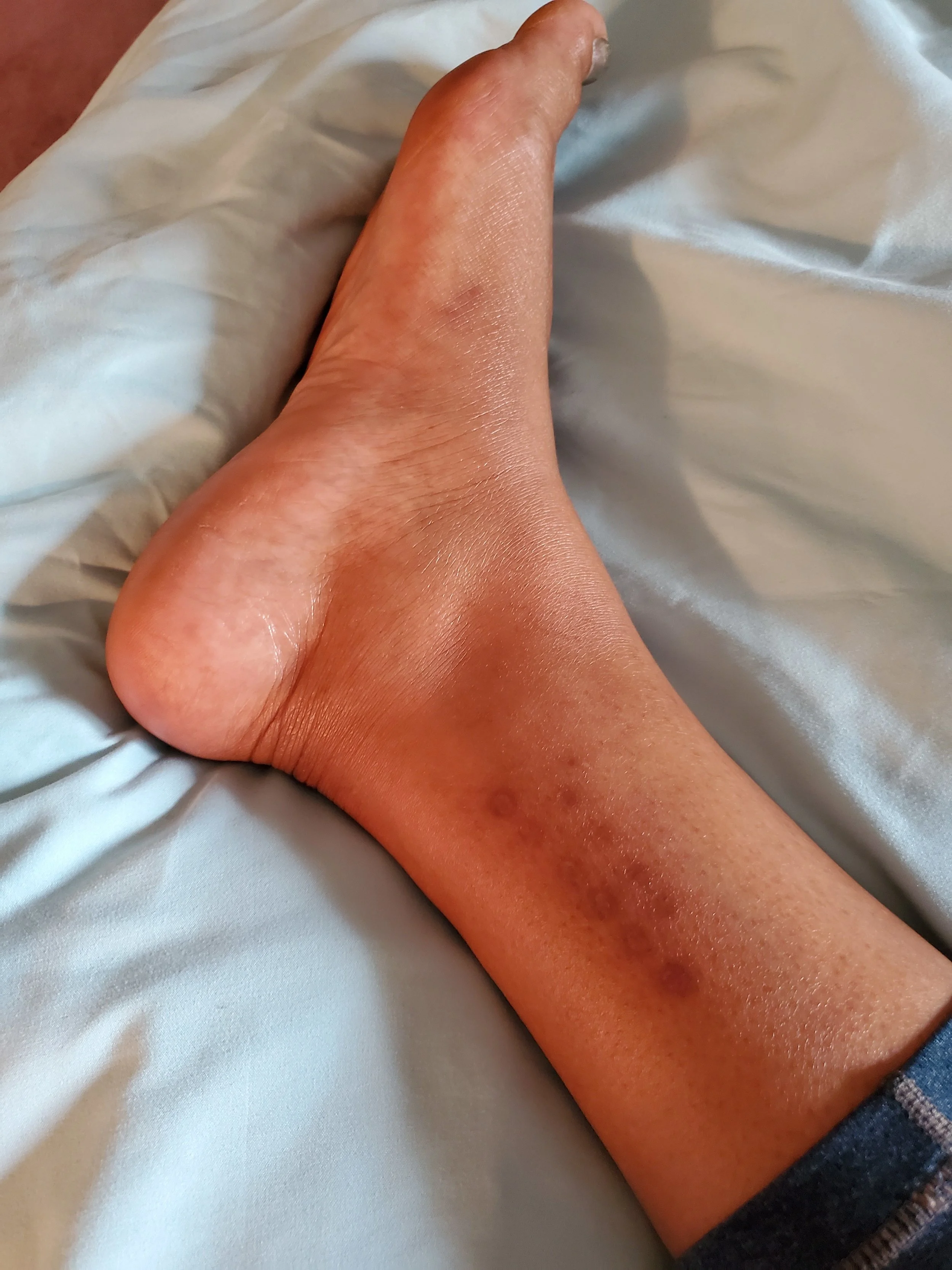 My Kambo scars after 3 ankle applications. I tended them so that the scars would be more prominent. I’m proud of the work that I did and the scars remind me of how strong I am.