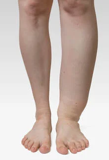 Lymphedema: What is it and how do we treat it?
