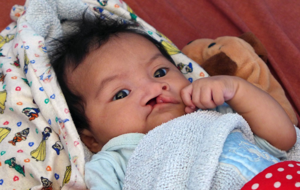 Baby waiting for cleft lip surgery