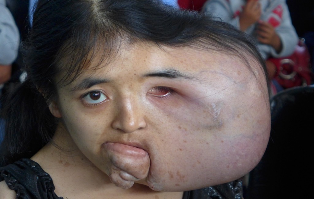 Young teenage girl with a large complex facial tumor, we are working on getting her transferred for care in the US
