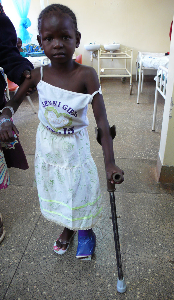Young girl clubfoot repair after