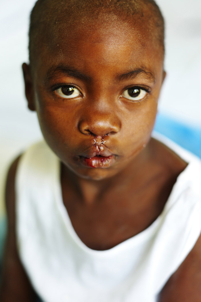 12 year old girl cleft lip repair after